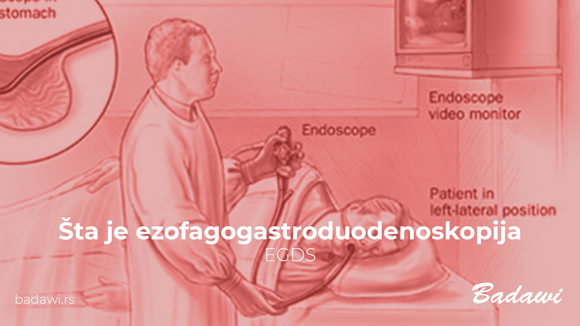Šta je ezofagogastroduodenoskopija – EGDS?