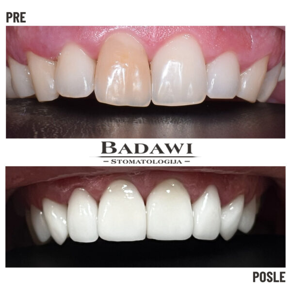 pre i posle v5